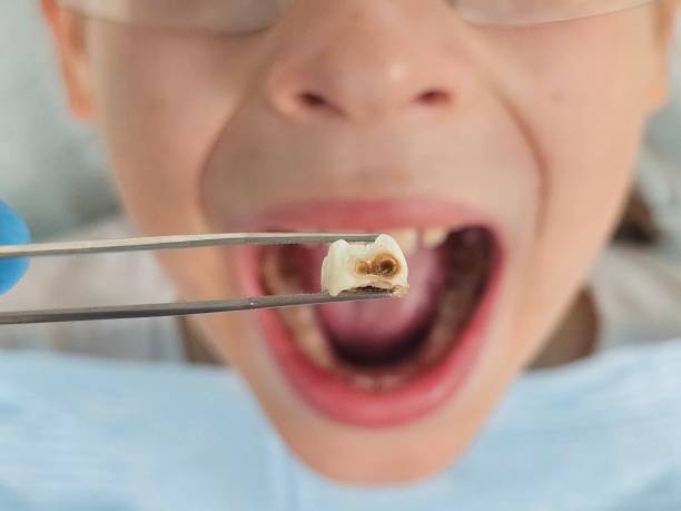 Best Urgent Care for Lost Fillings or Crowns in Lynchburg, OH